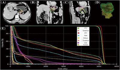 Case Report: MR-LINAC-guided adaptive radiotherapy for gastric cancer